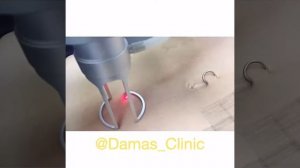 Лазерная шлифовка растяжек