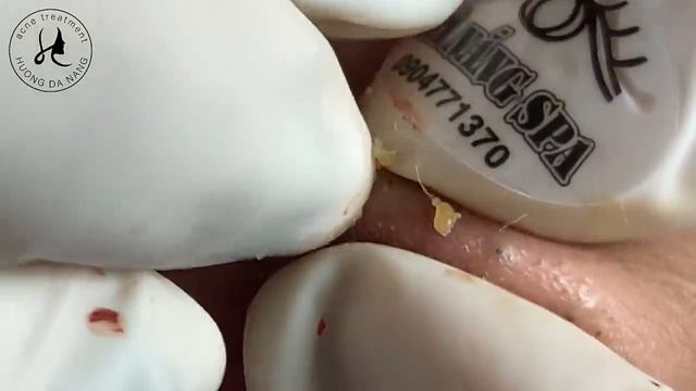 Huong Da Nang Acne Treatment #351 смотреть онлайн