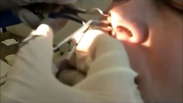 WORLDS BIGGEST BOOGER PULLED OUT OF NOSE *DISTURBING* смотреть онлайн