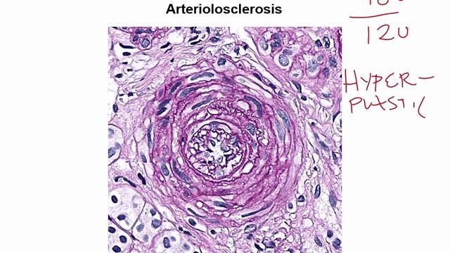 USMLE RX - 2.Кардиология - 3.Патология - 5.Артериосклероз