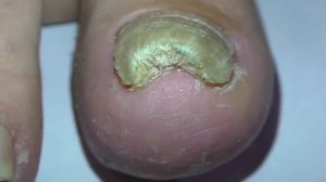 Грибок ногтей на ногах лечение в домашних условиях 1ч.