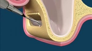 Открытый синус-лифтинг (техника и принцип)