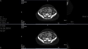 КТ брюшной полости