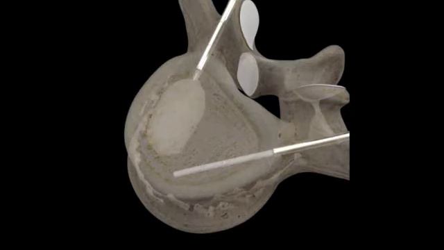 кифопластика смотреть онлайн