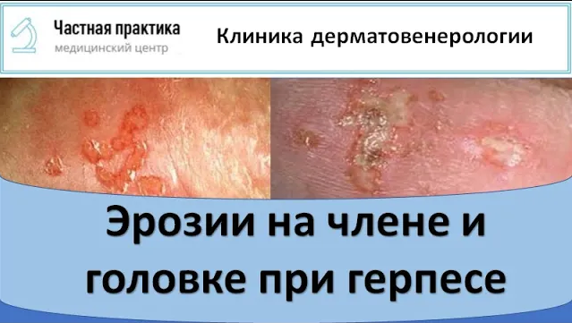 Эрозии на члене и головке при герпесе