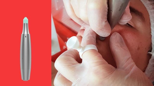 MicroActivationS Dermia Solution\ сепарация морщин, биоармирование век. Аппаратная биоревитализация