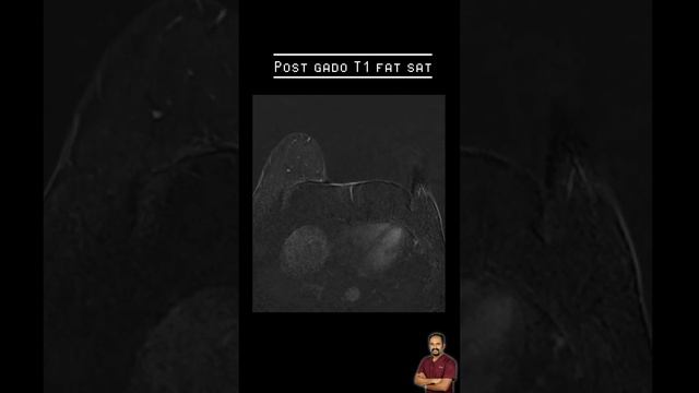 Some key signs of breast malignancy in MR mammogram