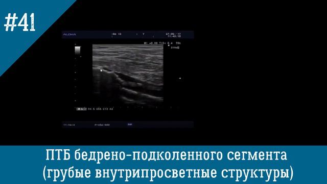 УЗИ Вен. Посттромботическая болезнь бедрено - подколенного сегмента.