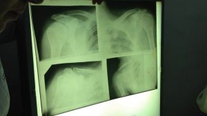 Рентген лопатки, ключицы