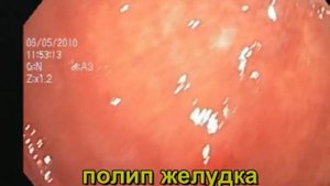 Полипы желудка небольших размеров. Удаление.