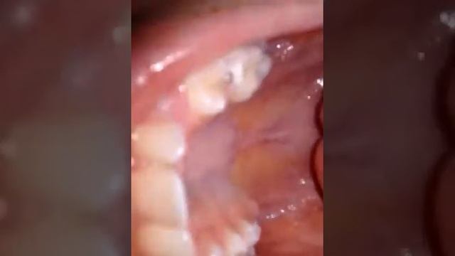 Сода ЛАЙВХАК чищу зубы содой