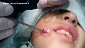 АБСЦЕДИРУЮЩИЙ ФУРУНКУЛ    9 СЕМ