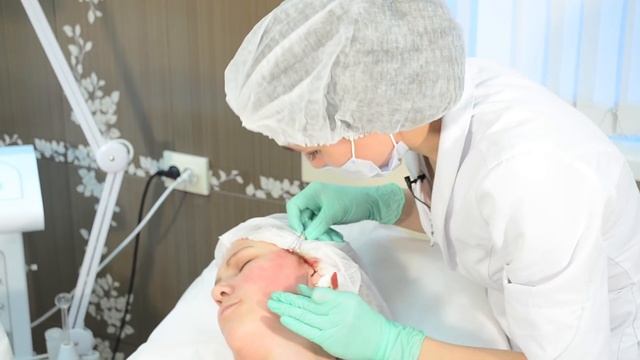 Нити с насечками для подтяжки лица, До и ПОСЛЕ, очень эффективный метод