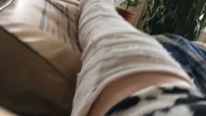 Перелом большеберцовой кости (2 день)