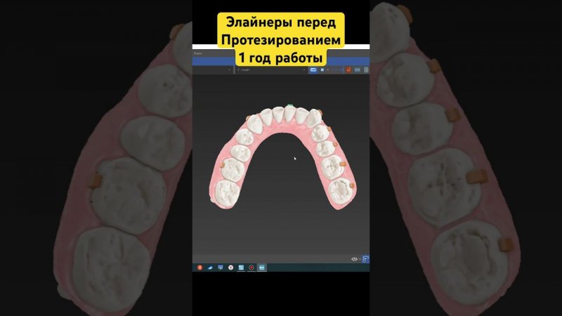 Элайнеры 1 год работы. Стас Белоус стоматолог Ульяновск