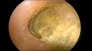 Удаление грибка из уха