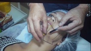 Пластика лица на аппарате Альтера.