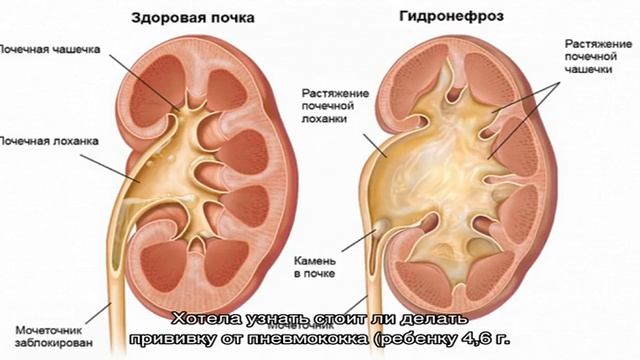 Плохой сон у ребенка с пороком сердца, гидронефрозом почек, двухсторонней водянкой яичек смотреть онлайн