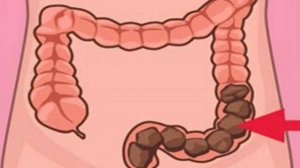 В кишечнике камни... Клетчатка уже не поможет