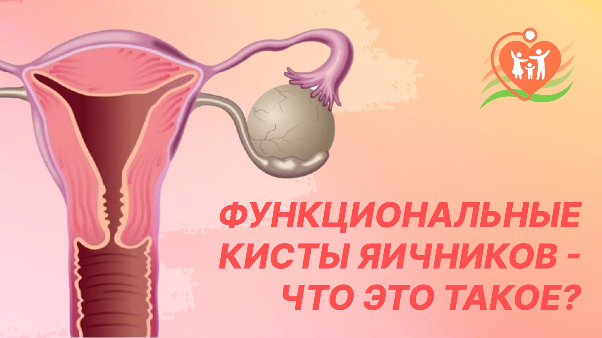 ? Функциональные кисты яичников - что это такое?