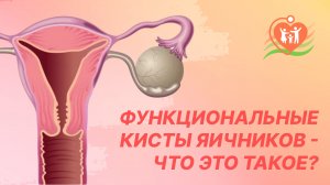 ? Функциональные кисты яичников - что это такое?