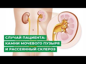 Случай пациента: камни мочевого пузыря и рассеянный склероз