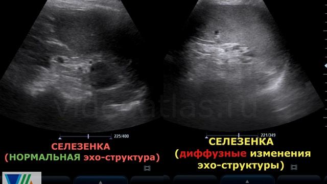 Диффузные изменения лж. Диффузные изменения селезенки. УЗИ селезенки. Изменения селезенки на УЗИ. Диффузные изменения селезенки на УЗИ.