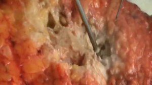 Липодеструкция