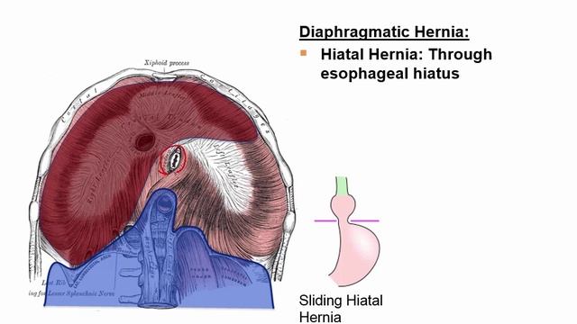 USMLE RX - 4.Желудочно-кишечный тракт - 1.Анатомия - 8.Грыжи