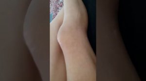 Перелом надколенника. Остеосинтез надколенника. Перелом надколенника со смещением.Часть 1