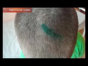 Клещ укусил ребенка в голову