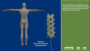 Интратекальное введение с помощью имплантационного насоса