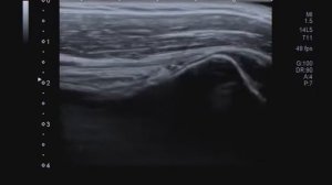 Сухожилие длинной головки бицепса плеча