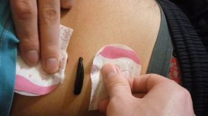 Пиявки.  Как мы ставим пиявок в домашних условиях на печень