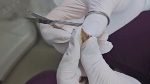 МОЗОЛЬ. РАЗГРУЗКА  #ногти #педикюр #подология #мозоль