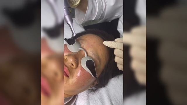 Xoá xăm - Dr Khai Le смотреть онлайн