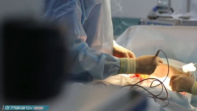Пластика живота. Лікар-хірург ВІКТОР МАКАРОВ смотреть онлайн