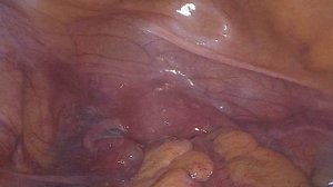 Лапароскопическая передняя резекция прямой кишки