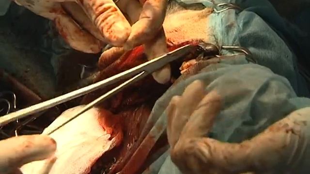 Опухоль ротовой полости. Видео 2. смотреть онлайн