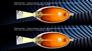 Лазерная коррекция зрения