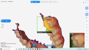 QuickScan IOS by Runyes in Action! New 3D Intraoral Scanner to Meet Your Digital Dentistry Needs.