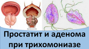 Простатит и аденома простаты при трихомониазе