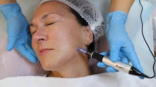 ✨ФРАКЦИОННАЯ МЕЗОТЕРАПИЯ / Mesoterapia fraccional смотреть онлайн