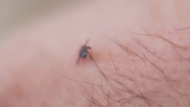 Как правильно удалить клеща и транспортировать его в лабораторию смотреть онлайн