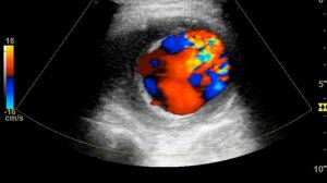 Аневризма больших размеров общей бедренной артерии