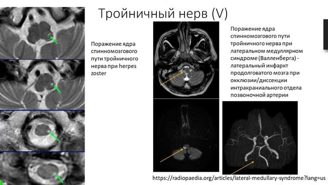 Булахова И. Н. МРТ диагностика черепно-мозговых нервов смотреть онлайн