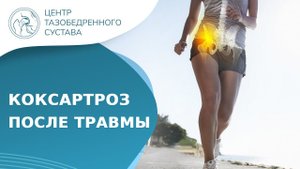 Когда развивается посттравматический артроз тазобедренного сустава? Посттравматический артроз. 18+