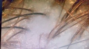 Трихоскопия: зачем, как и для чего?