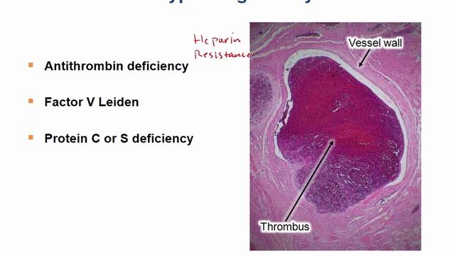 USMLE RX -5.Гематология и онкология -2.Патология -Синдром наследственного тромбоза = гиперкоагуляция