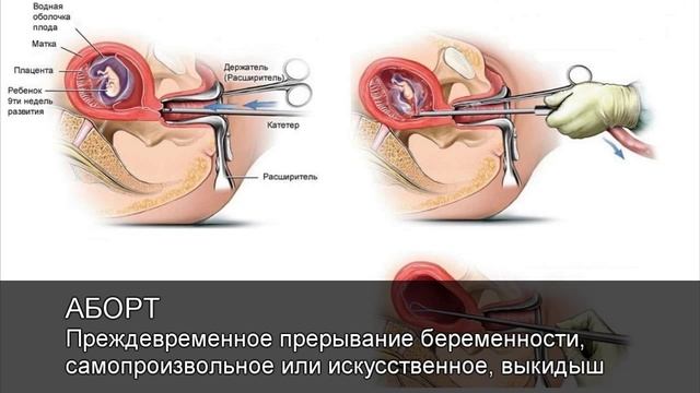 Аборт.Толковый Видеословарь русского языка смотреть онлайн